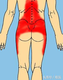 退行性腰椎管狭窄的治疗方法,腰椎管狭窄症初期症状