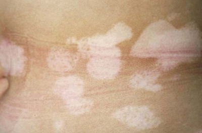 湿疹有可能诱发白癜风吗,久治不愈的湿疹会诱发白癜风吗