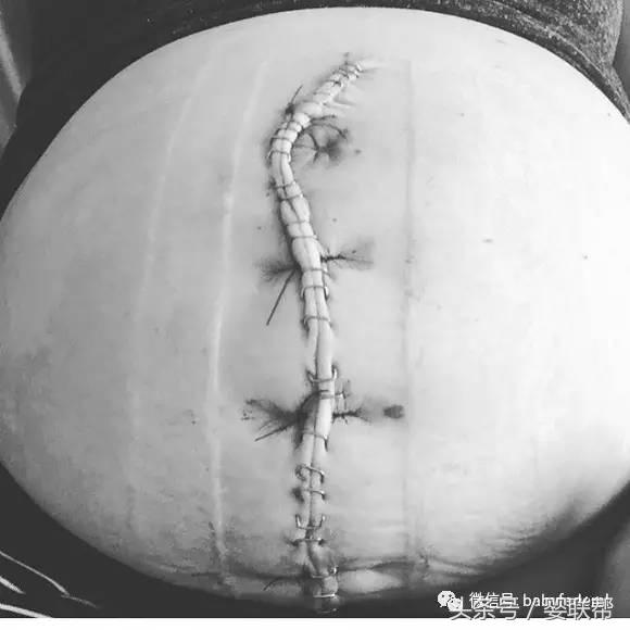 先别被图片吓到，这位剖腹产妈妈的自白让无数人感动