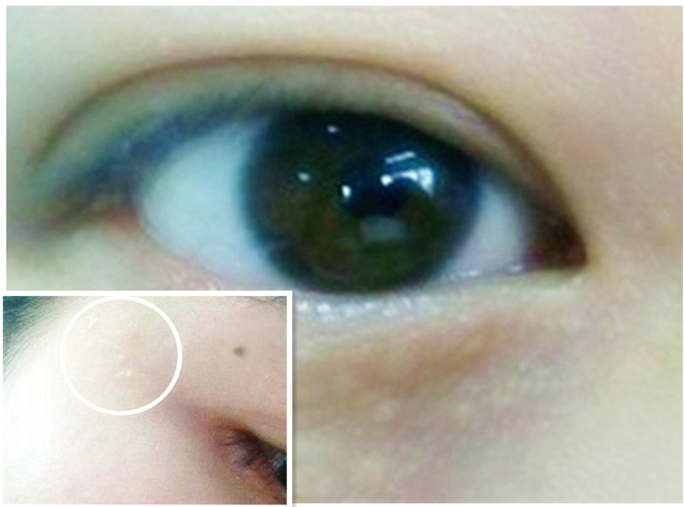 长了脂肪粒会自己脱落吗,长了脂肪粒用什么护肤品