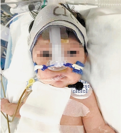 婴儿出生15天确诊心脏病手术成功,刚出生一个月的宝宝做心脏手术