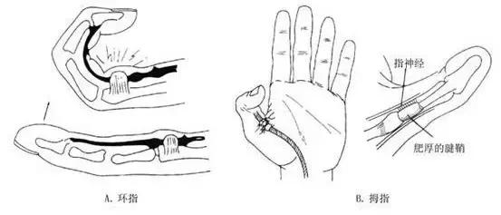 手机玩多了大拇指手腕痛,手机玩多了手指疼怎么缓解