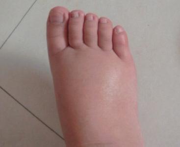 孕妇脚肿是怎么缓解呢,孕妇脚肿怎么办最有效的方法