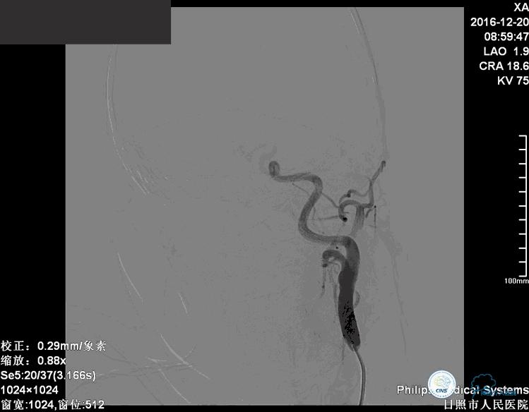 颈动脉瘤介入栓塞康复后可活多久,动脉瘤微创栓塞术全过程