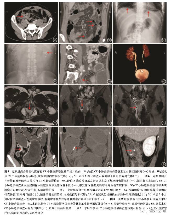 克罗恩病外科并发症的影像学特征