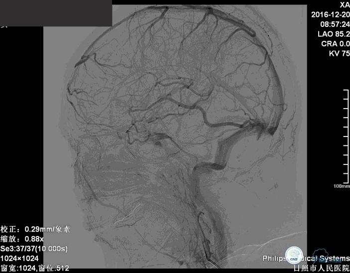 颈动脉瘤介入栓塞康复后可活多久,动脉瘤微创栓塞术全过程