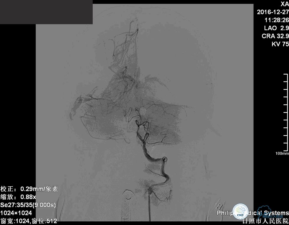 颈动脉瘤介入栓塞康复后可活多久,动脉瘤微创栓塞术全过程