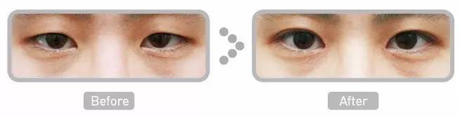 双眼皮手术韩式整形,韩国医生做幽灵手术