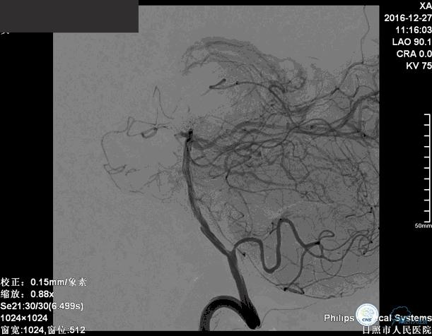 颈动脉瘤介入栓塞康复后可活多久,动脉瘤微创栓塞术全过程