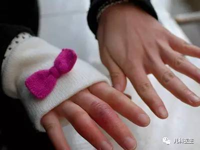 儿童脸上冻疮怎么处理,儿童冻疮怎么快速治疗最快最有效