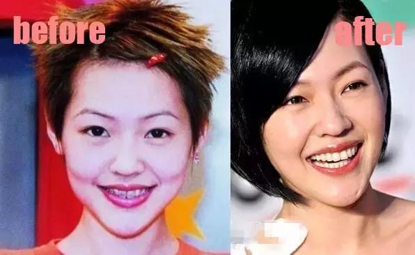 整牙=整容？看杨幂、刘涛、高圆圆为你亲身示范！