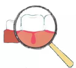 蛀牙牙疼怎么缓解最有效方法,没有蛀牙为什么也会牙疼