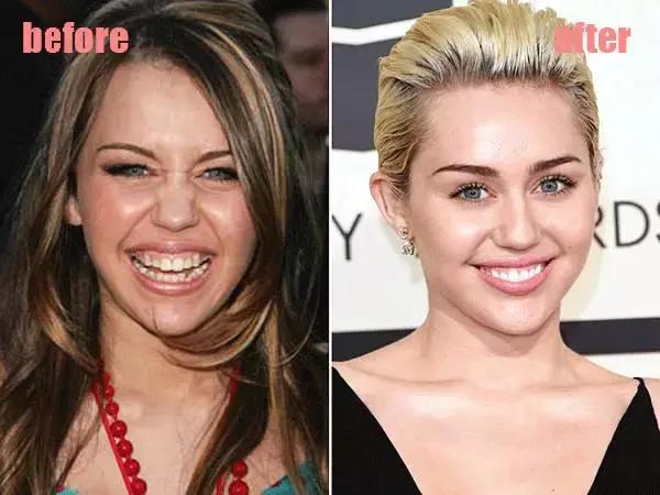 整牙=整容?看杨幂、刘涛、高圆圆为你亲身示范!