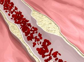 清理血管壁最佳中药配方,清理血管壁的方子