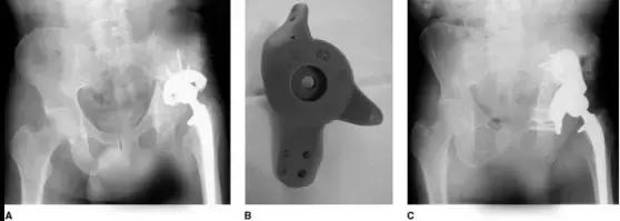髋臼骨质破坏一般怎么治,髋臼骨缺损