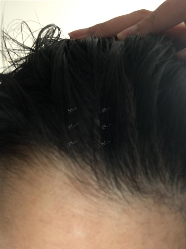 治疗头皮痒头皮屑偏方,治疗头皮发红大片头皮屑的方法