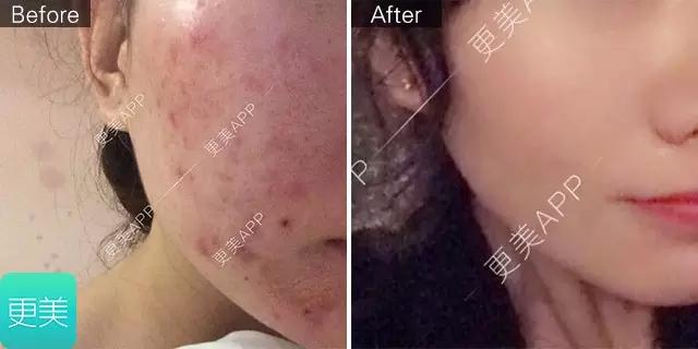 长痘痘好焦虑啊,长痘痘要用什么药治疗