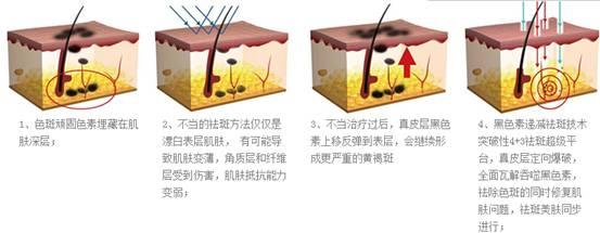 雀斑的治疗误区有哪些呢,雀斑治疗误区