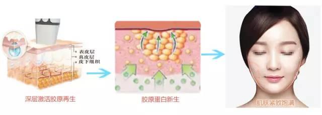 做完超声刀可以吃硬东西吗,超声刀做完必须用医用面膜吗