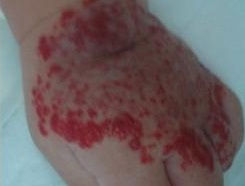 哪种方法可以治疗蔓状血管瘤,蔓状血管瘤治疗最好的方法