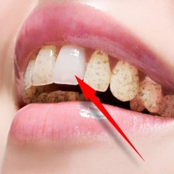 牙齿冷光美白一次就能变白吗,冷光美白牙齿您了解的有多少