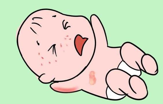 宝宝起干性湿疹用加湿器能缓解吗,金银花洗澡可以缓解婴儿湿疹吗