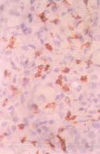 红色斑丘疹是湿疹吗,红斑丘疹误诊湿疹