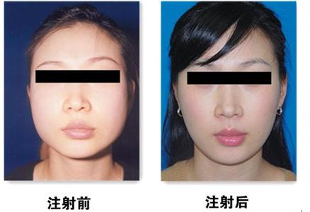 只打一次瘦脸针后咬肌能恢复多少,注射瘦脸针来瘦咬肌可以维持多久