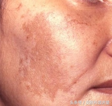 身上的褐斑慢慢长大了该怎么办,褐斑的原因及治疗方法