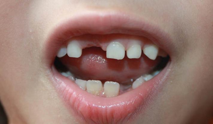 梦见自己掉牙齿是什么预兆,梦见自己掉牙齿是什么意思