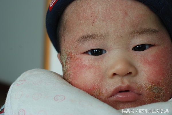 宝妈如何对抗婴儿湿疹,宝妈课堂专业基础知识