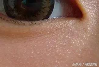 怎么区分汗管瘤脂肪粒还是粟丘疹,眼周的脂肪粒不去除