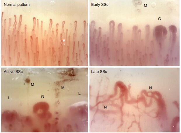 多发性硬化症和系统性硬皮病,系统性硬皮病有什么症状