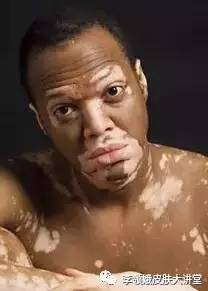 白癜风的鉴别诊断,白癜风的鉴别诊断有哪些