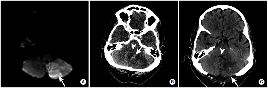 多图颅内出血影像学表现大全,头被撞后颅内出血有什么表现