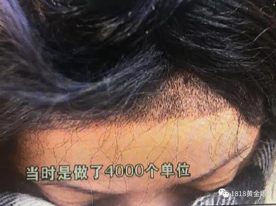 杭州年轻女子花了一万元做手术,女子花了100多万做头发