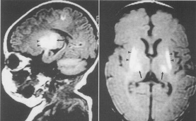 婴儿大便墨绿色是吓到了吗,为什么一个多月的宝宝大便有点黑