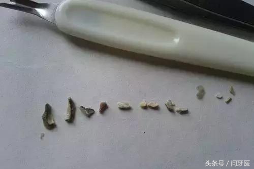 过年牙齿掉了一块,过年牙齿掉好不好