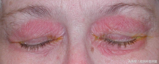 反复神经性皮炎是缺什么,神经性皮炎反反复复如何根除