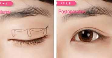 纳米无痕双眼皮埋线怎么恢复得快,埋线双眼皮拆线能恢复到原来吗