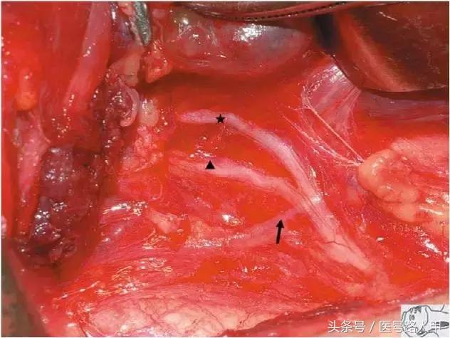 喉返神经的解剖视频,损伤喉上神经和喉返神经的区别
