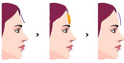 自体脂肪可以填额头吗,广东自体脂肪丰额头