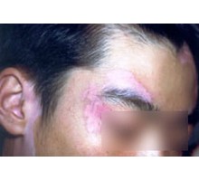 怎样治疗白癜风效果好呢,肢端型白癜风用308治疗有效吗