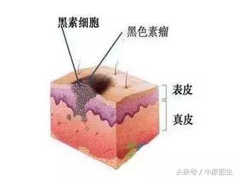 黑痣要小心谨防黑色素瘤,黑痣与黑色素瘤的五大区别