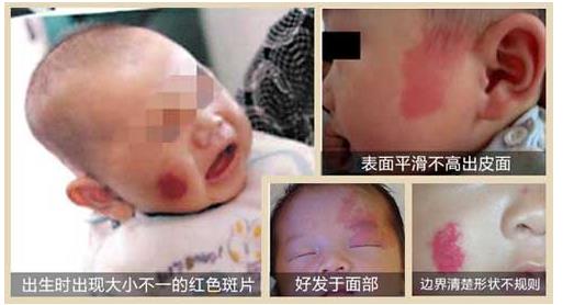 孕妈有鲜红斑痣会遗传吗,鲜红斑痣是基因病吗