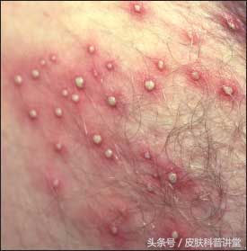 皮肤科普健康知识讲座,皮肤病种类图毛囊炎