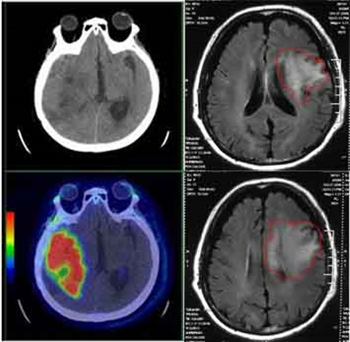 老年人头痛想吐什么原因,老人呕吐是中风前征兆吗