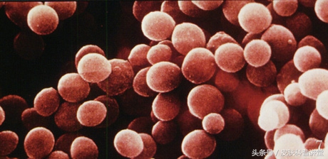 一张图教你辨别脓疱疮,皮肤科普直播