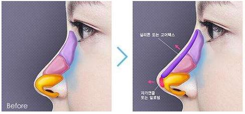 耳软骨隆鼻垫鼻尖缺点,隆鼻耳软骨垫鼻尖发白