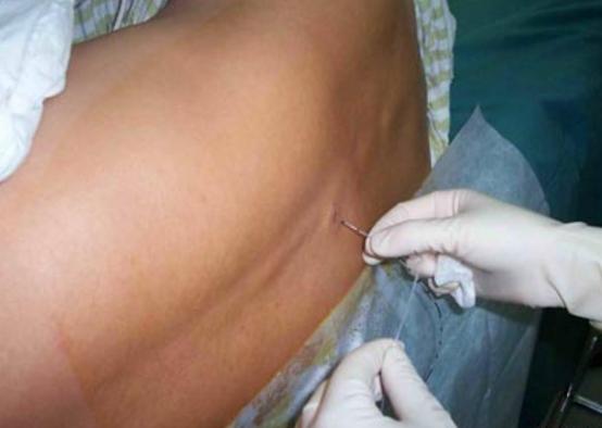 剖腹产三年了还痛又痒怎么回事,剖腹产快2年了偶尔还隐隐疼